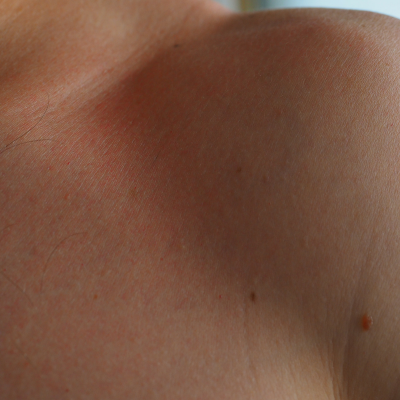 Getting Rid of Old Scarring