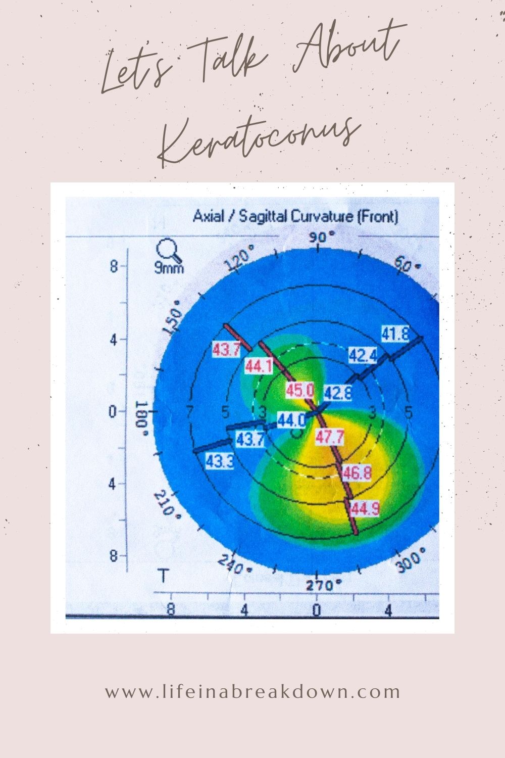 A topographic map of the eyes axial/sagittal curvature, indicating keratoconus. The map shows color-coded curvature levels. Text above reads Lets Talk About Keratoconus and below is a website link: www.lifeinabreakdown.com.