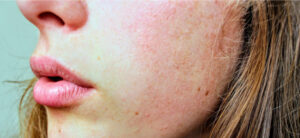Header Hyperpigmentation