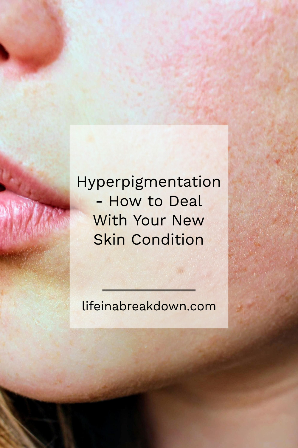 Are you suffering from hyperpigmentation? Then check out this post on the best ways to deal with this skin issue and why it happens. #skincare #skincondition #skintips
