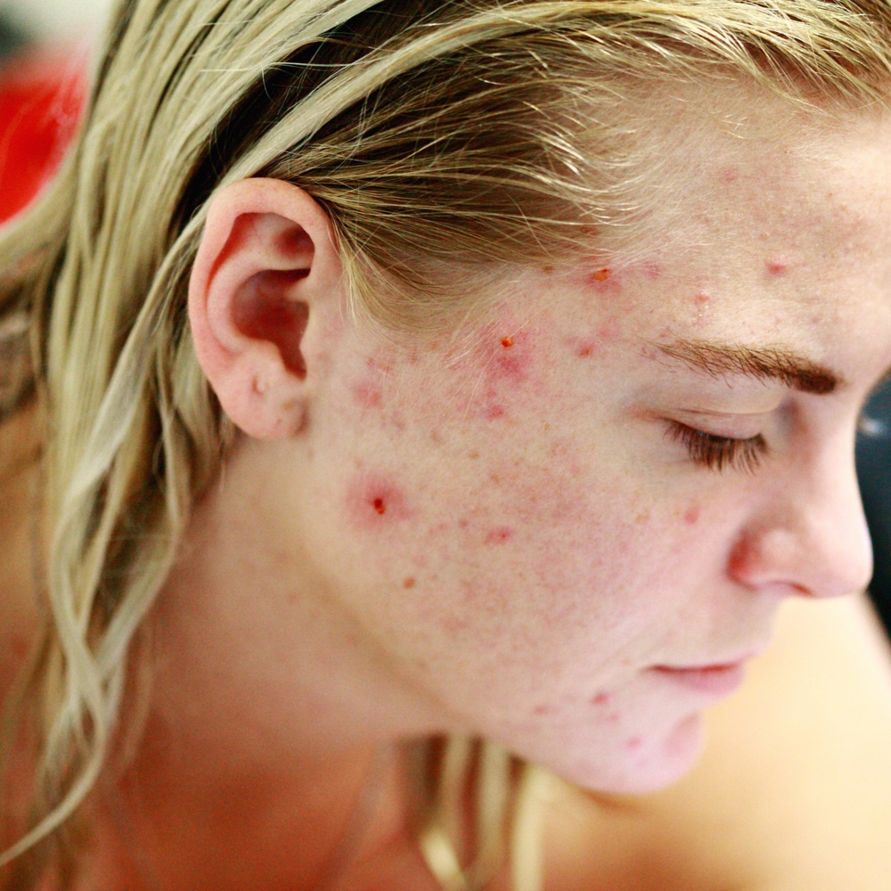 acne on a womens face