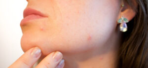 Close-up of a person touching their chin, with a focus on skin imperfections like small pimples. The person is wearing glittery nail polish and sparkly earrings.