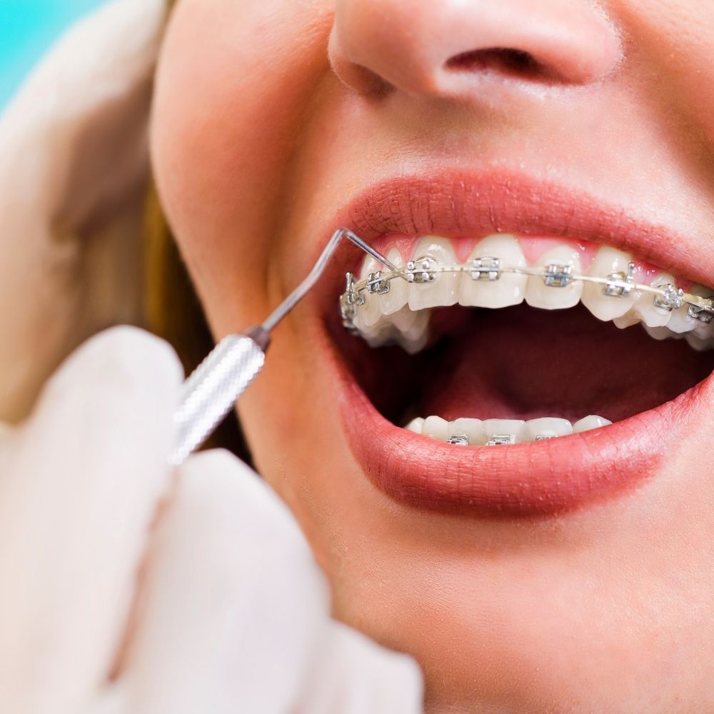 dentist looking at a womens teeth who is wearing braces