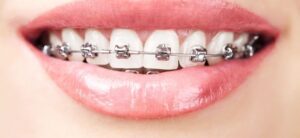 photo of a mouth with braces on the teeth