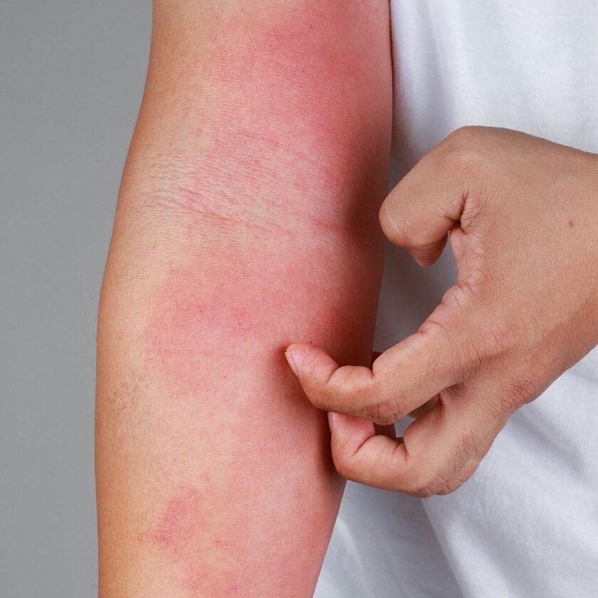 Eczema allergy skin