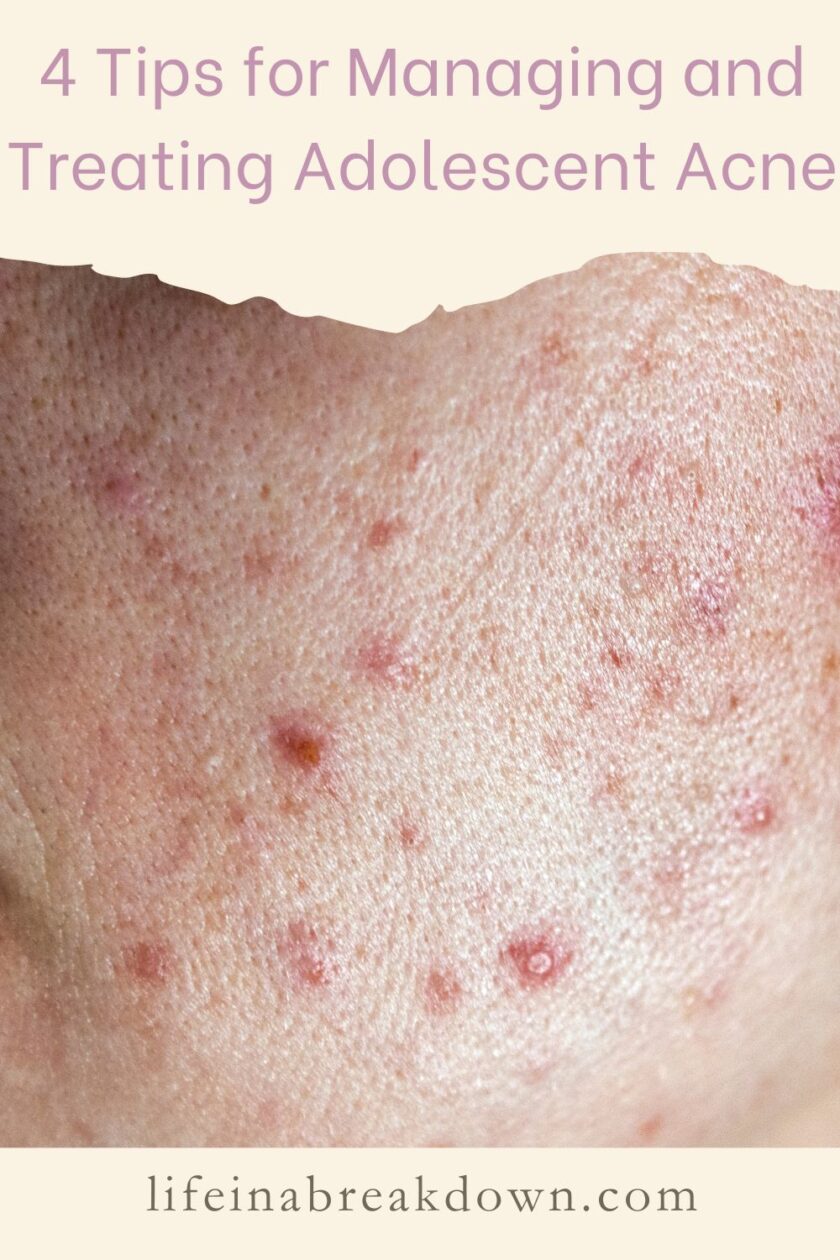 Are you struggling with acne as a young person or adolescent? Then here are some hints and tips to help you manage your skin.