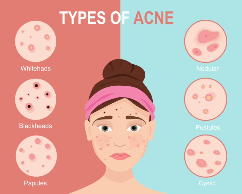 Types of acne with woman. Cosmetology and skincare problems. Acne types. Vector illustration