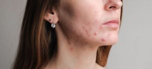young woman with acne problems