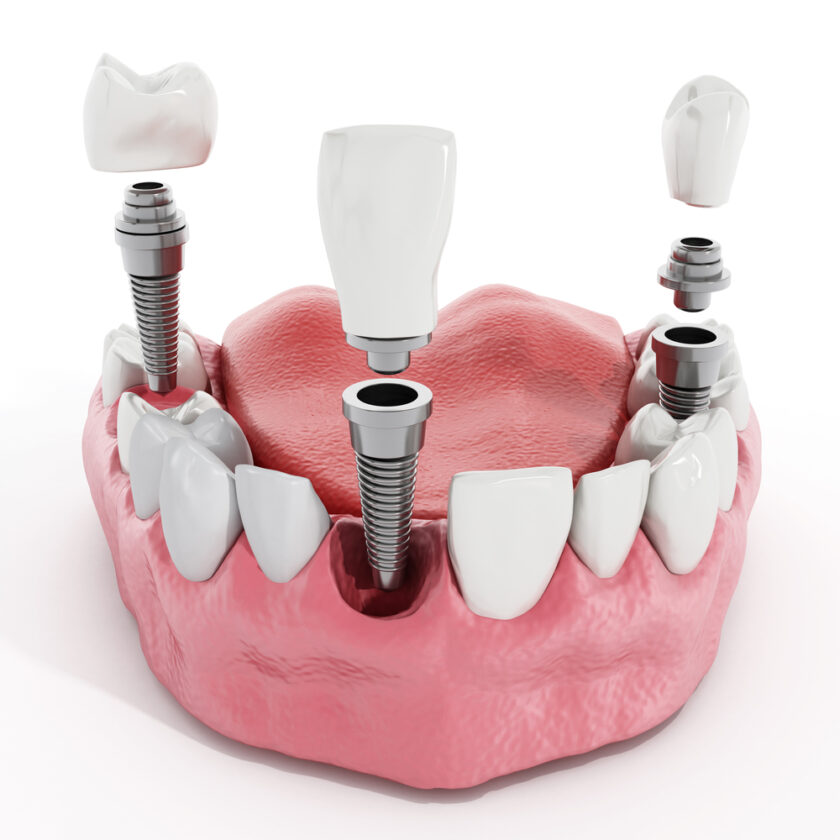 Illustration of teeth showing dental implant structure