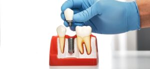 dental implants