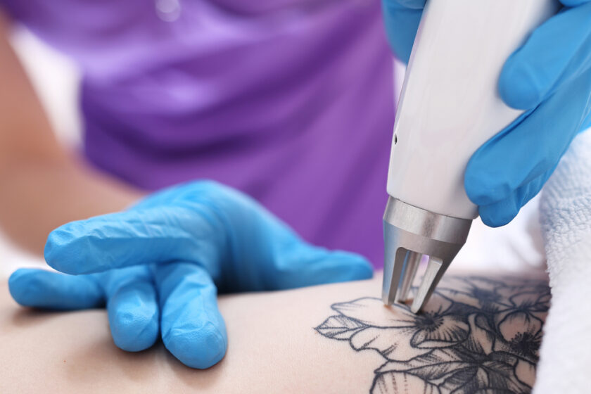 Laser Tattoo Removal