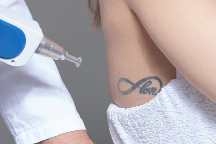 laser tattoo removal in clinic closeup