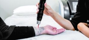 laser tattoo removal