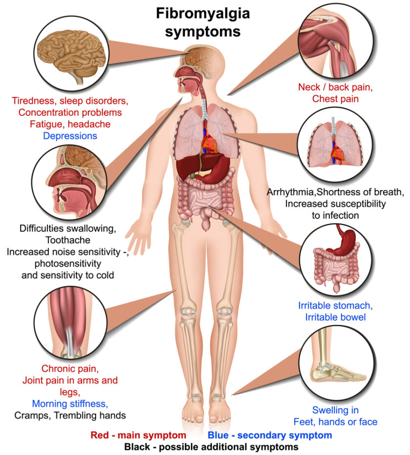 Image showing some ofthe symptoms of fibromyalgia