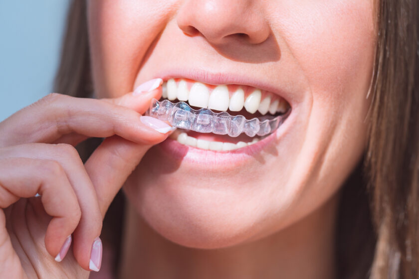 Woman with perfect smile wearing invisible dental aligners for dental correction.