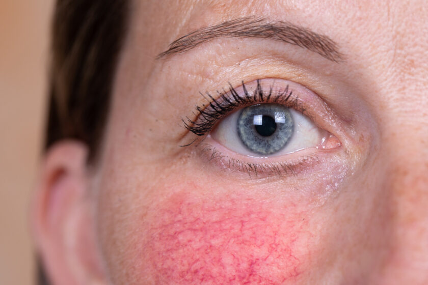 A closeup view on the face of a young woman suffering with rosac
