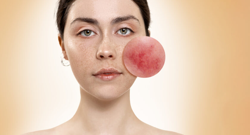 Close-up portrait of a beautiful young woman, with an zoomed circle on her cheek, showing inflamed blood vessels. Beige background. Rosacea treatment concept.