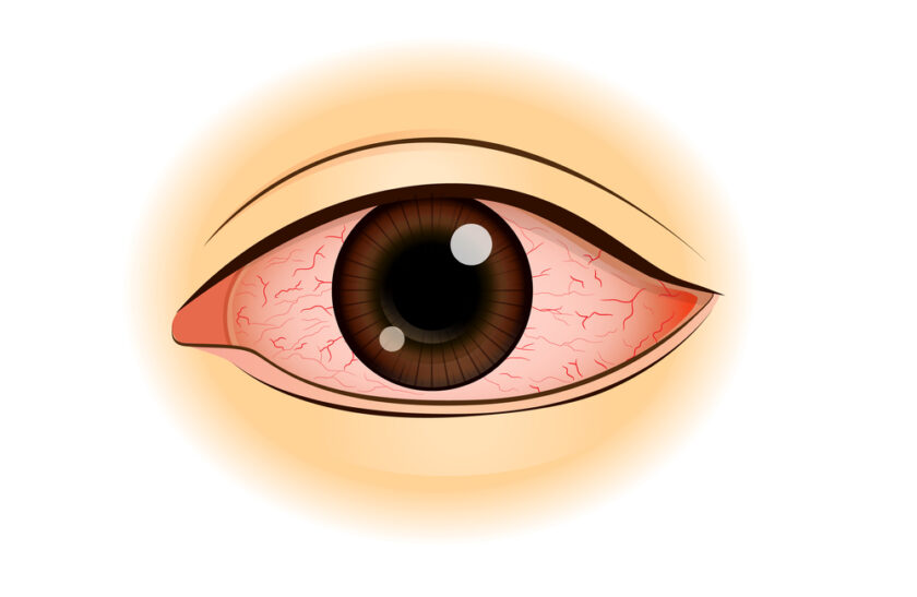 Illustration of a human eye with visible redness and bloodshot veins, indicating irritation or possible infection, surrounded by a slight yellowish hue.