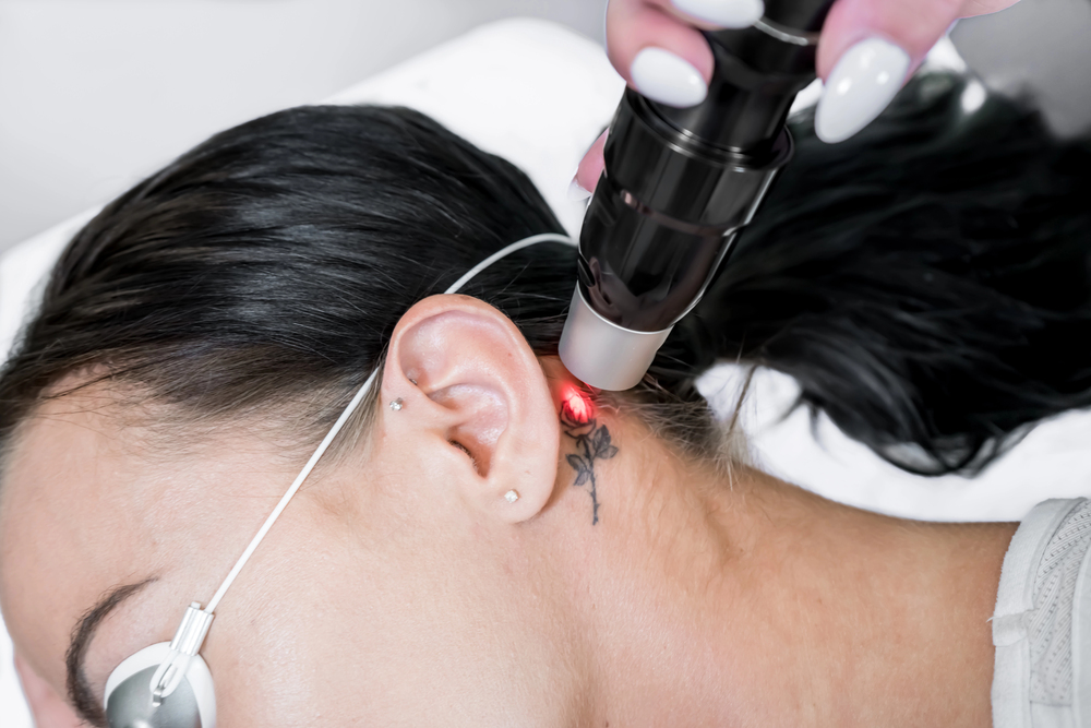 A person with dark hair and protective eyewear undergoes laser tattoo removal on a small black tattoo behind their ear. A gloved hand holds the laser device emitting a red light onto the tattoo.