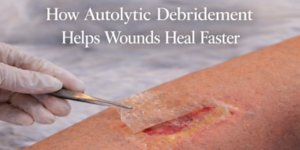 A gloved hand uses tweezers to lift a transparent film from a wound on a person's leg, illustrating autolytic debridement. The text reads How Autolytic Debridement Helps Wounds Heal Faster.