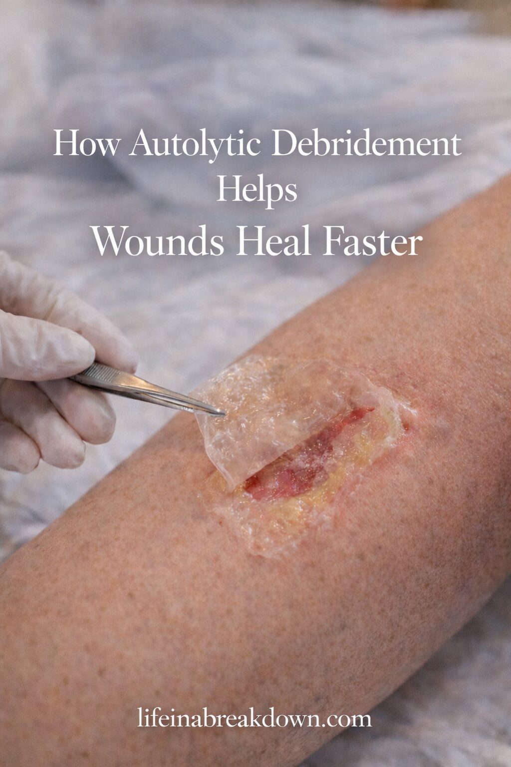 A gloved hand uses tweezers to lift a translucent film from a wound on a person’s leg, demonstrating autolytic debridement. Text overlay reads, How Autolytic Debridement Helps Wounds Heal Faster.