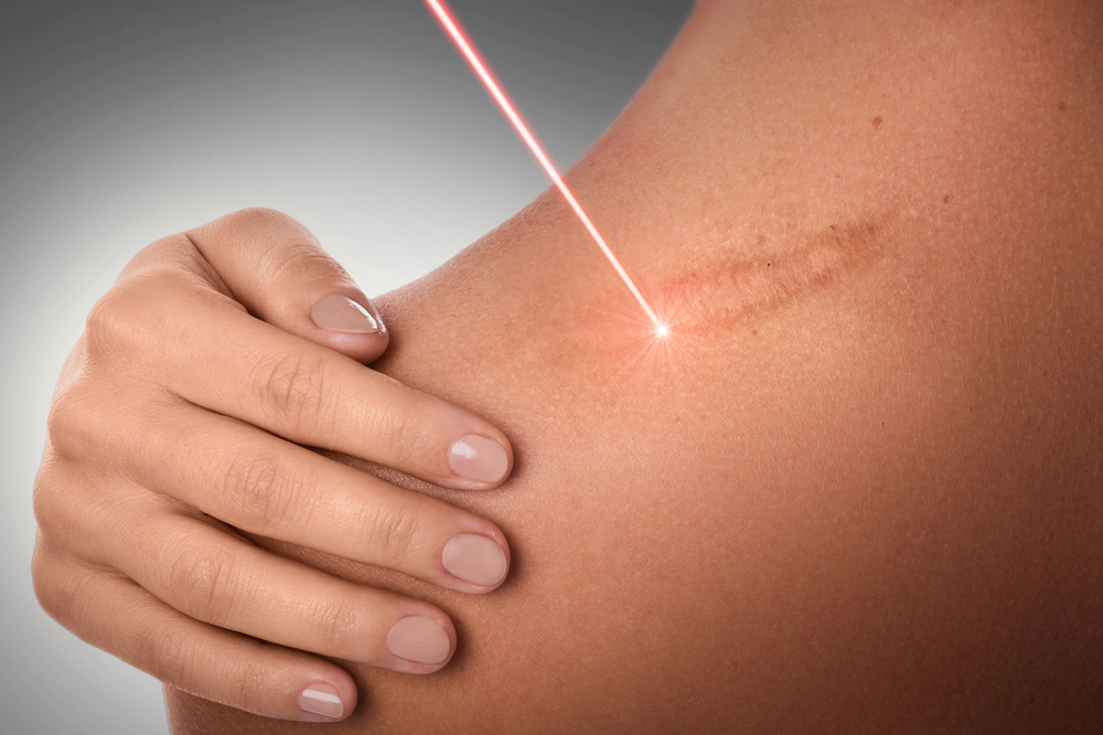 A hand touches a shoulder with a visible scar while a laser beam targets the scar, suggesting laser treatment for scar removal.