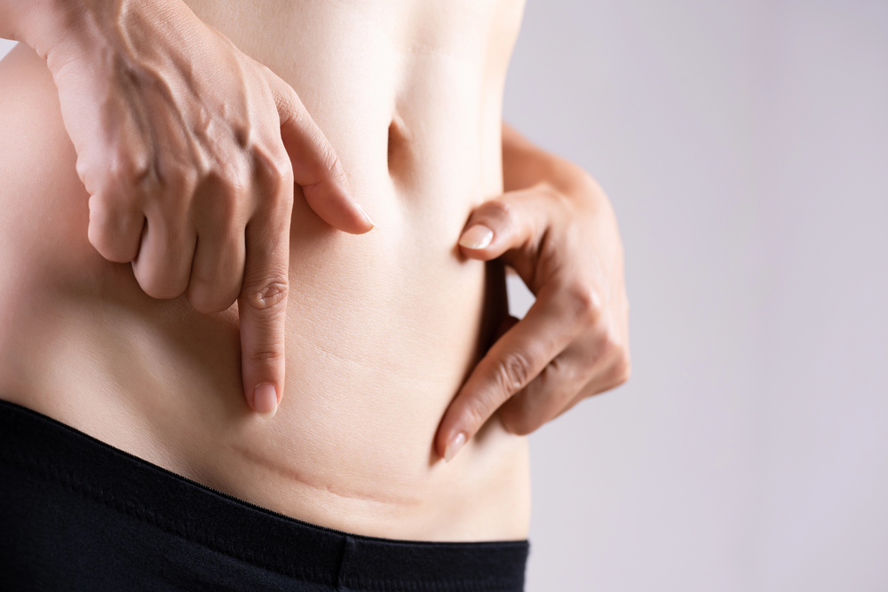 A person points to a horizontal scar on their lower abdomen, just above the waistband of black trousers.