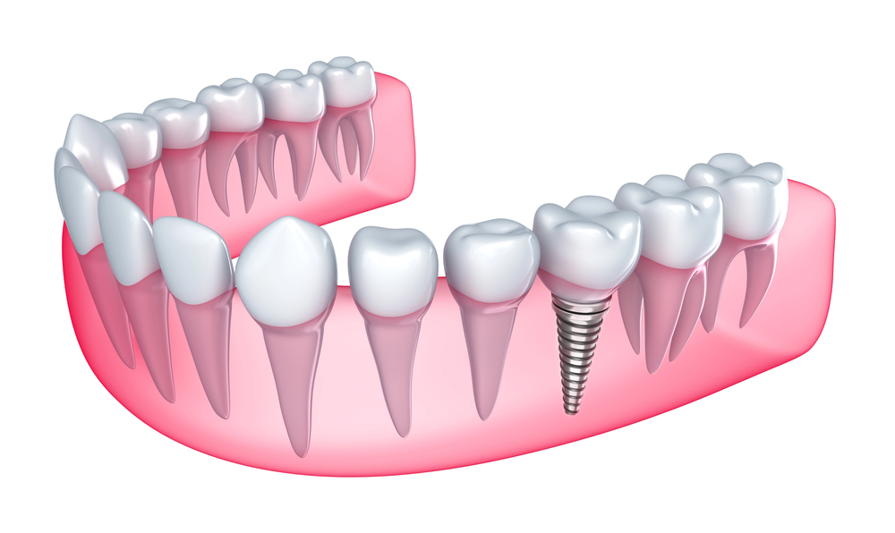 3D illustration of a lower jaw with teeth, showing a dental implant with a metal screw replacing a missing tooth among natural teeth.