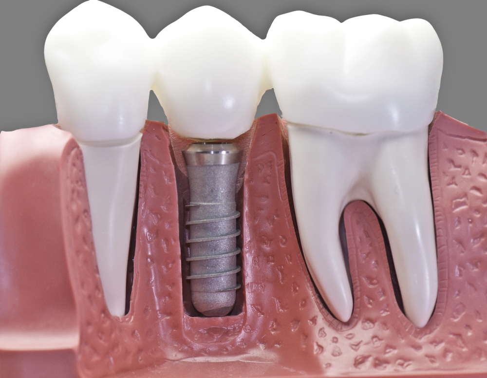A dental model showing three teeth, with the middle tooth replaced by a metal dental implant embedded in the pink gum and jawbone.