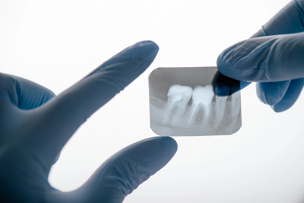 Hands in blue medical gloves hold up a dental X-ray showing two teeth with fillings.